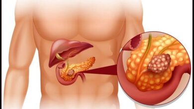 لبلبے کے سرطان کی عام علامات کیا ہیں؟