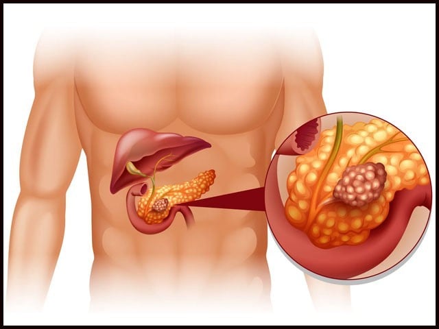 لبلبے کے سرطان کی عام علامات کیا ہیں؟