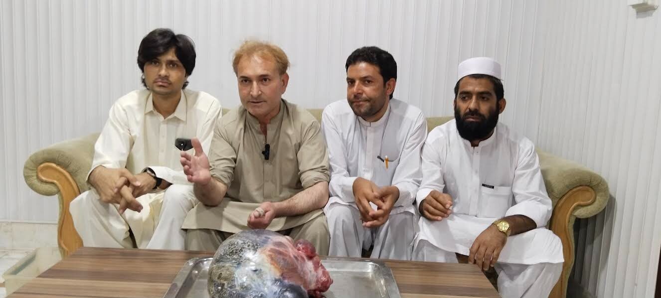 مسرت شوکت میڈیکل کمپلکس: 65 سالہ خاتون کی 14 کلو وزنی رسولی کا کامیاب آپریشن