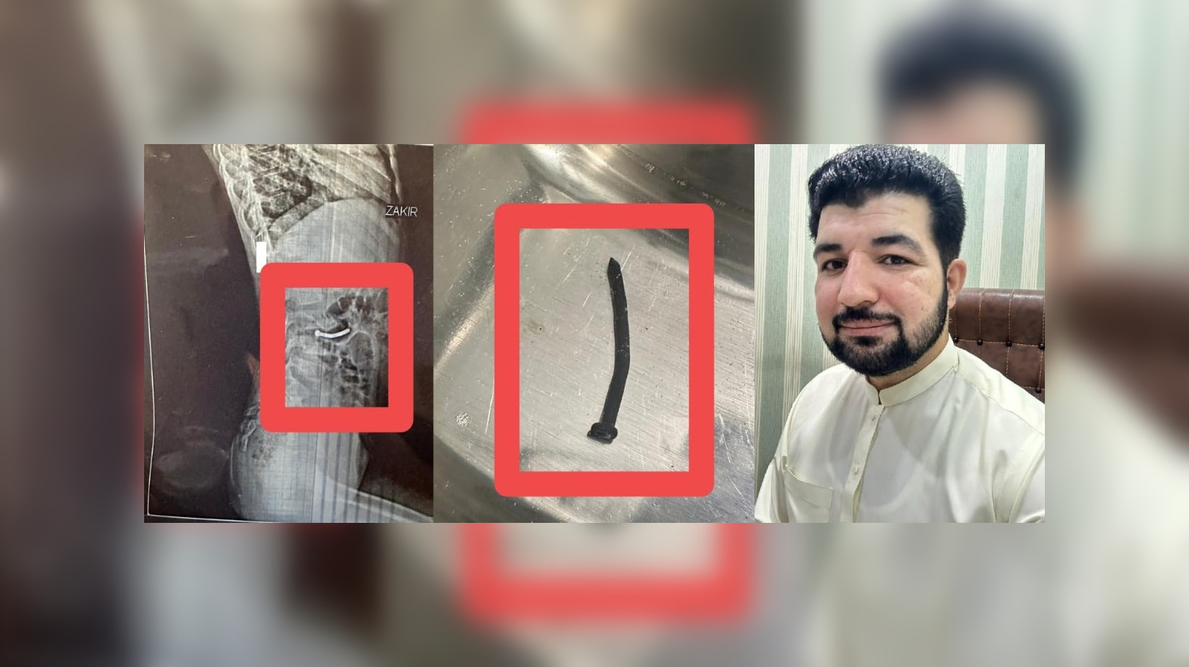 ڈاکٹر نے 8 سالہ بچی کی آنت سے کیل نکال کر بڑی سرجری سے بچالیا